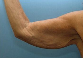 Brachioplasty Before & After Image