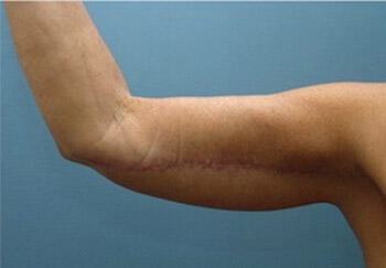 Brachioplasty Before & After Image