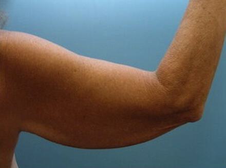 Brachioplasty Before & After Image