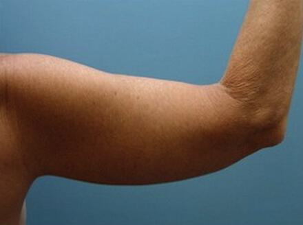 Brachioplasty Before & After Image
