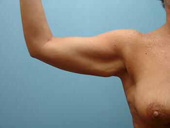 Brachioplasty Before & After Image