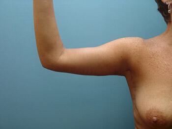 Brachioplasty Before & After Image