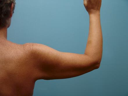 Brachioplasty Before & After Image