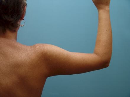 Brachioplasty Before & After Image