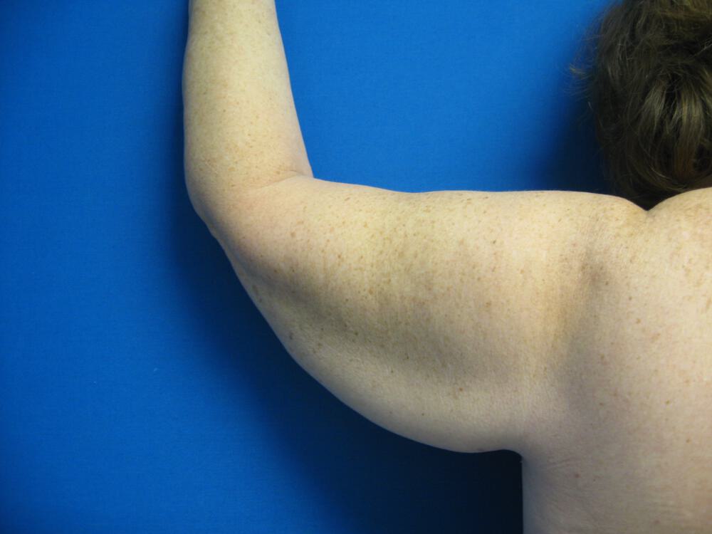 Armlift Before & After Image