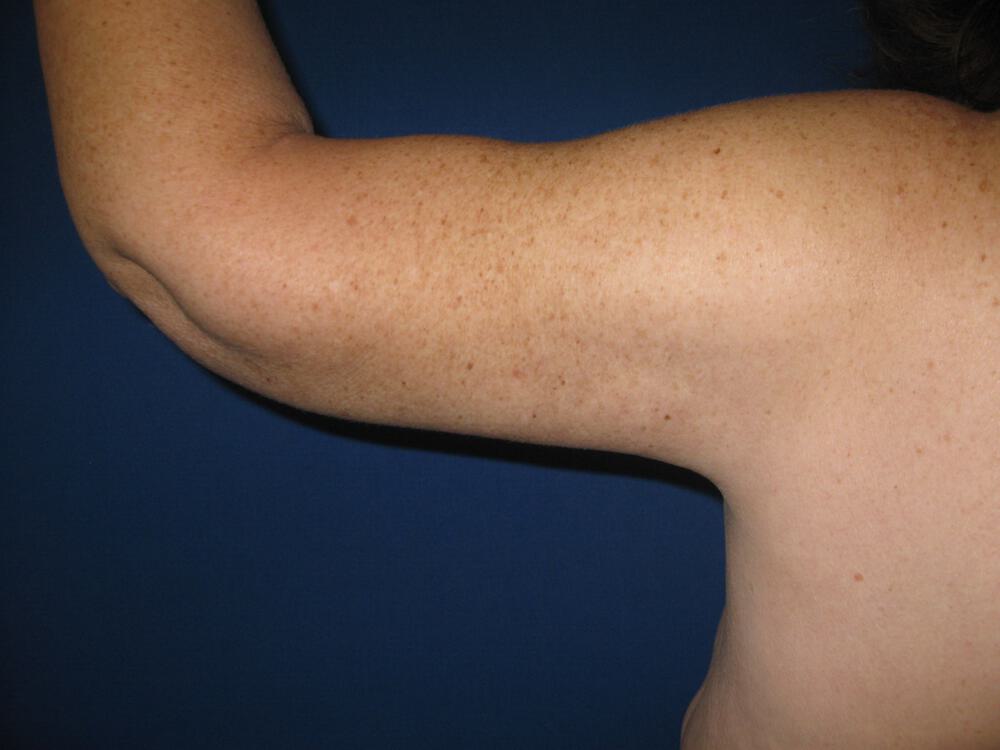 Armlift Before & After Image