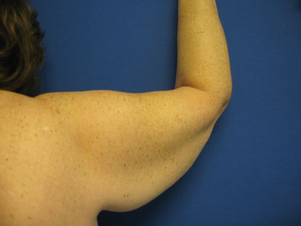 Armlift Before & After Image
