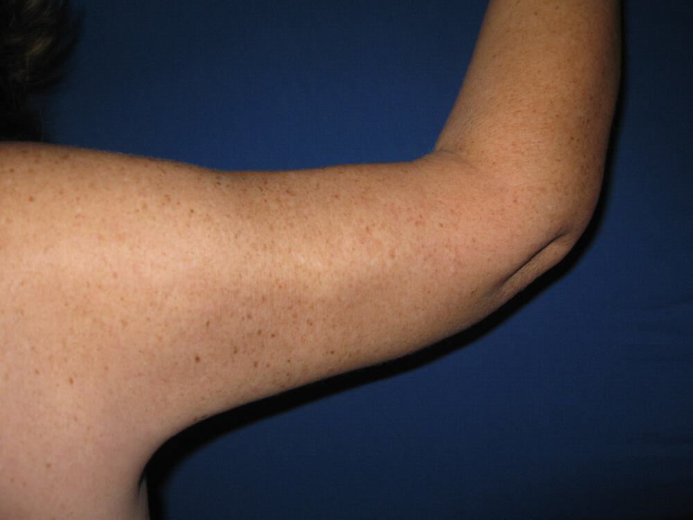 Armlift Before & After Image
