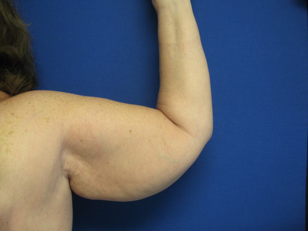Brachioplasty Before & After Image