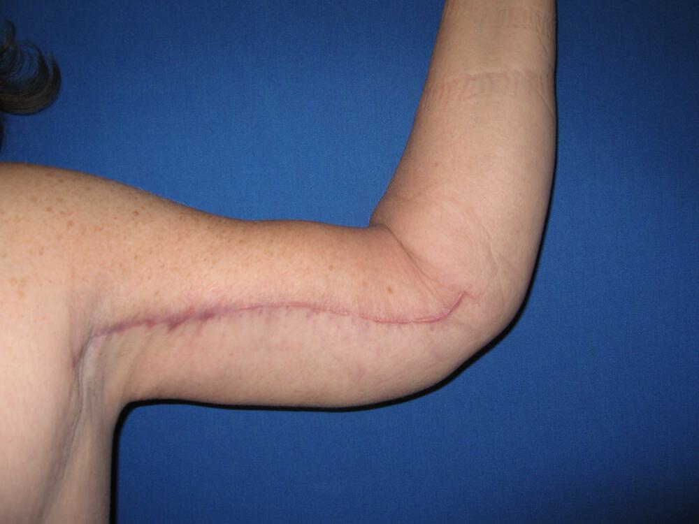 Brachioplasty Before & After Image