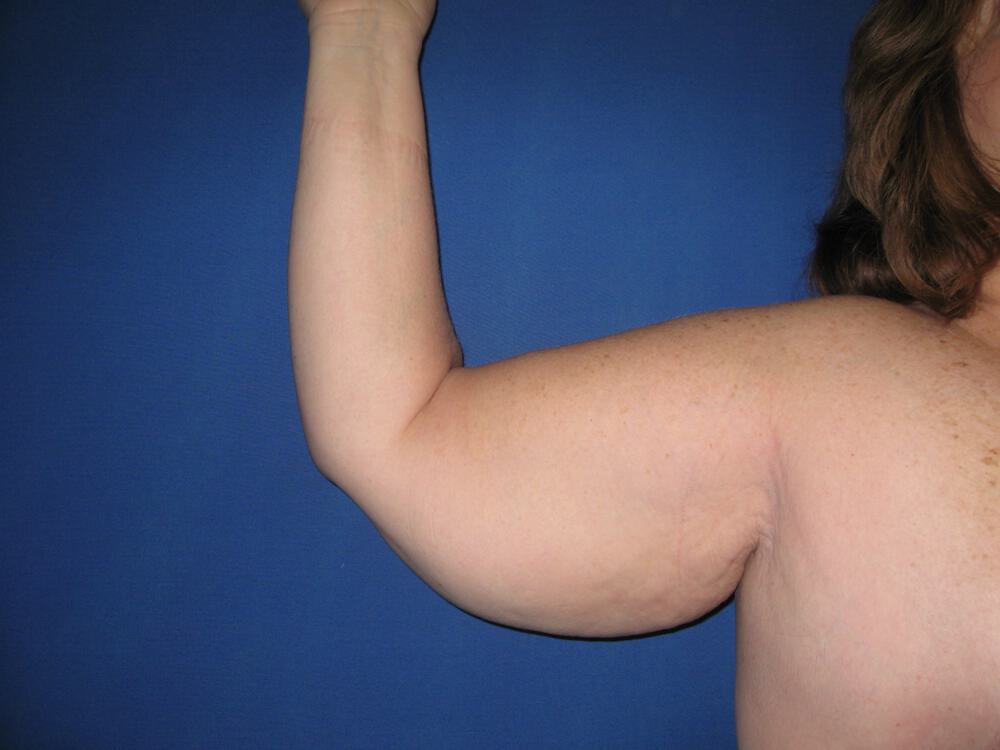 Brachioplasty Before & After Image