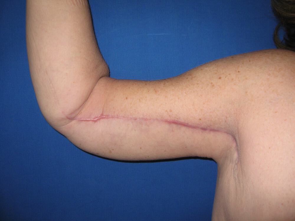 Brachioplasty Before & After Image