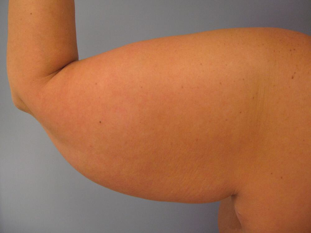 Armlift Before & After Image