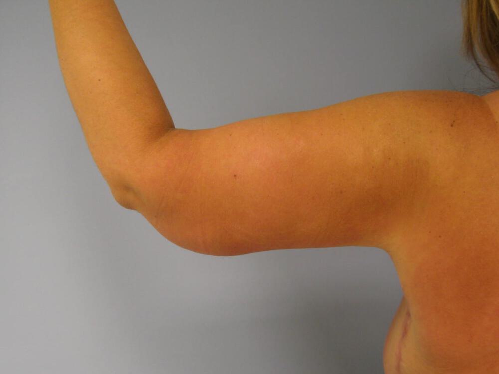 Armlift Before & After Image