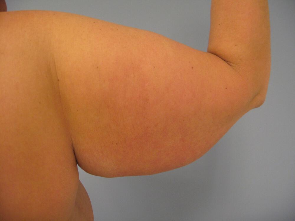 Armlift Before & After Image