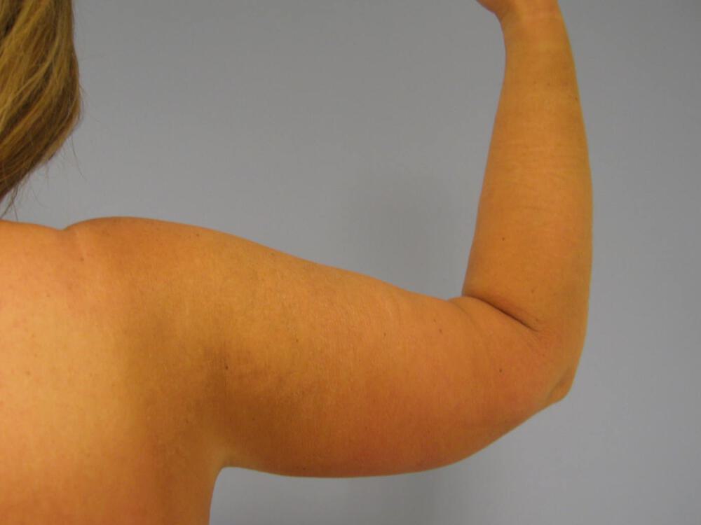 Armlift Before & After Image