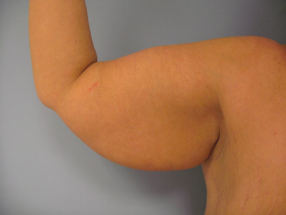 Brachioplasty Before & After Image