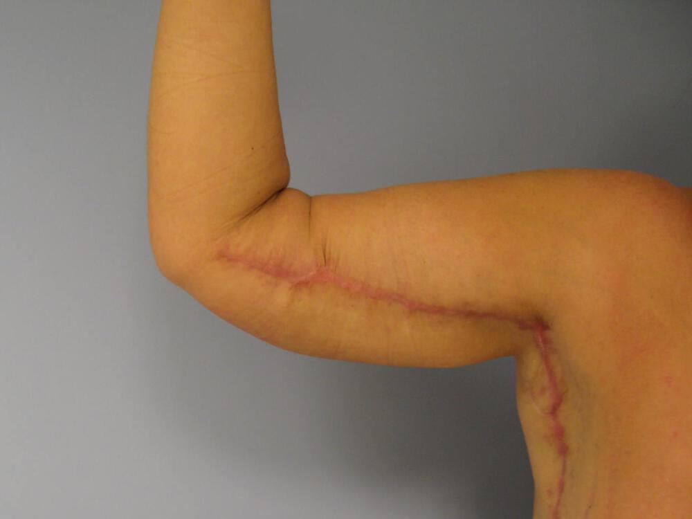 Brachioplasty Before & After Image
