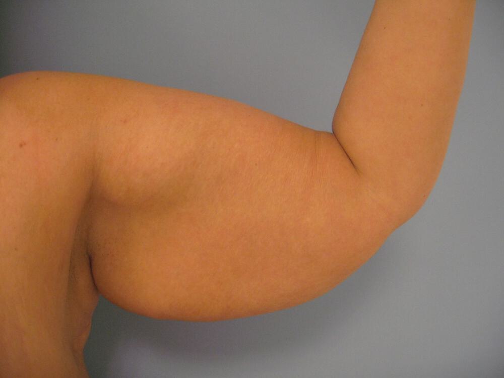 Brachioplasty Before & After Image