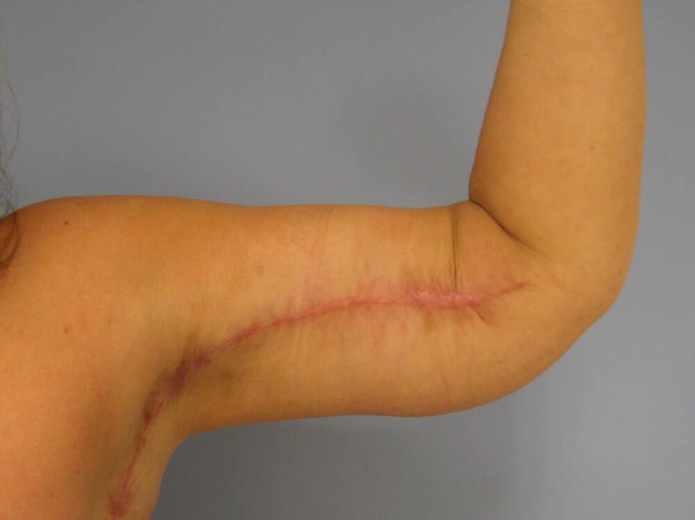 Brachioplasty Before & After Image