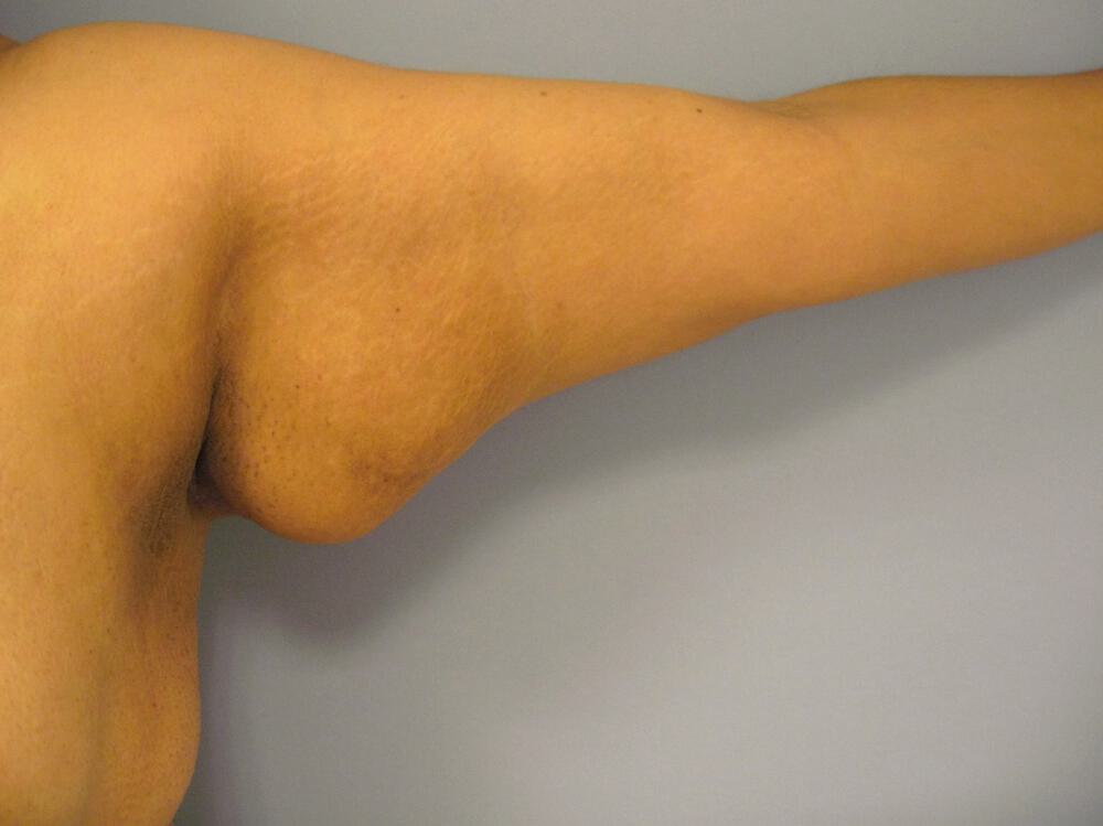 Armlift Before & After Image