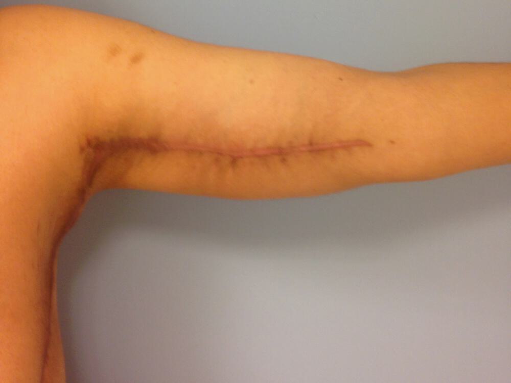 Armlift Before & After Image