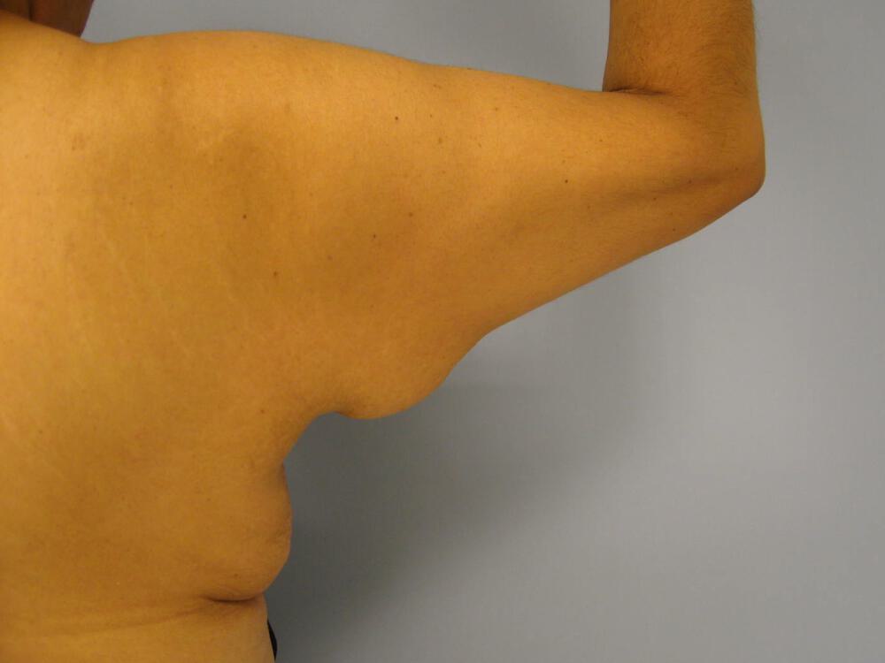 Armlift Before & After Image