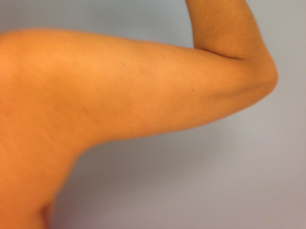 Armlift Before & After Image