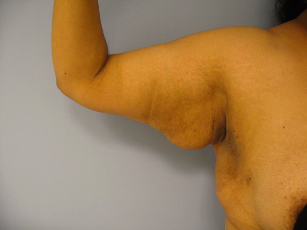 Brachioplasty Before & After Image