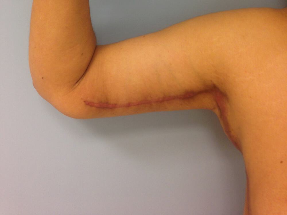 Brachioplasty Before & After Image