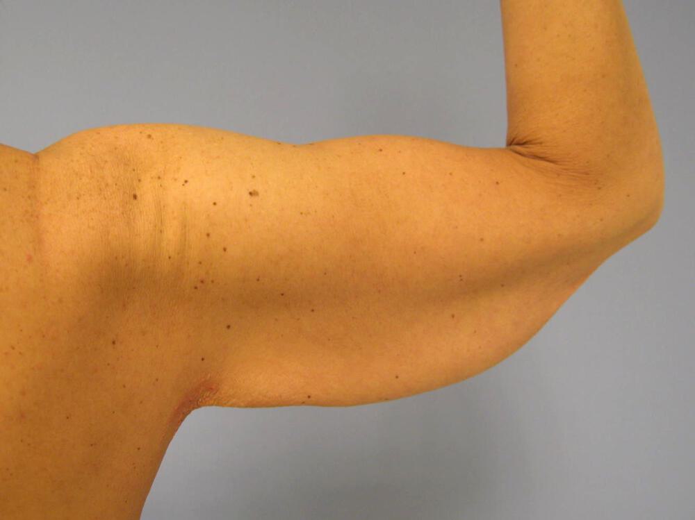 Armlift Before & After Image