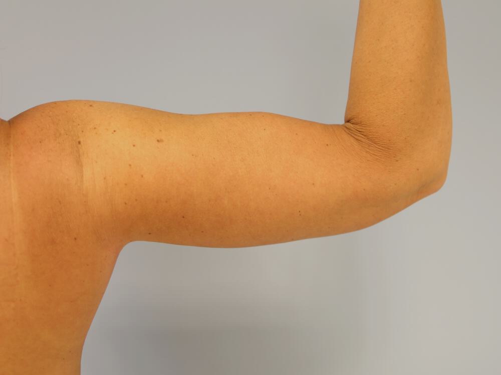 Armlift Before & After Image
