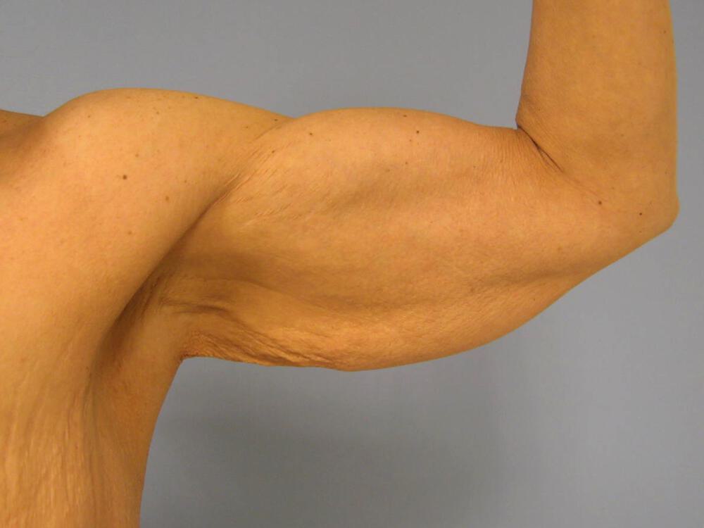 Armlift Before & After Image