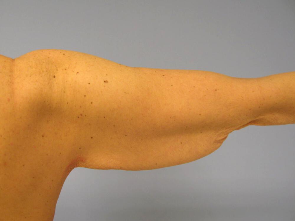 Brachioplasty Before & After Image