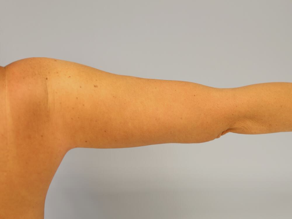 Brachioplasty Before & After Image
