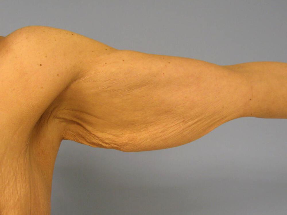Brachioplasty Before & After Image