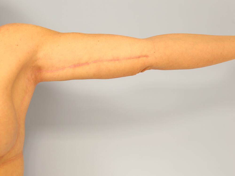 Brachioplasty Before & After Image
