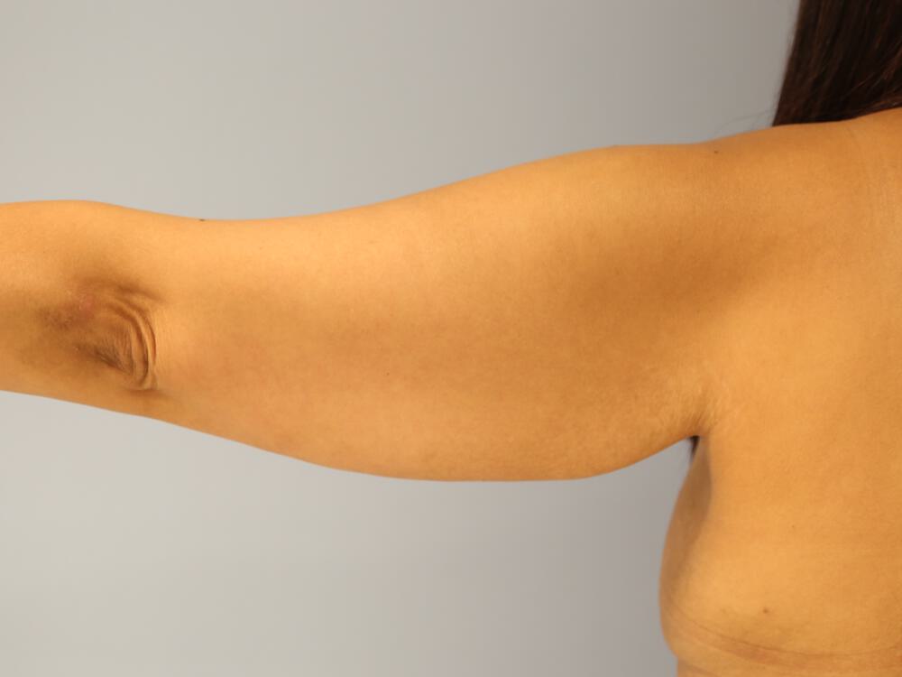 Armlift Before & After Image