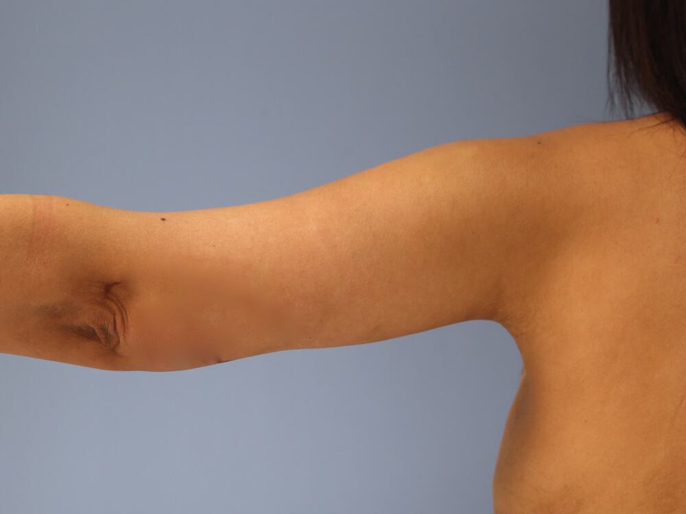 Armlift Before & After Image