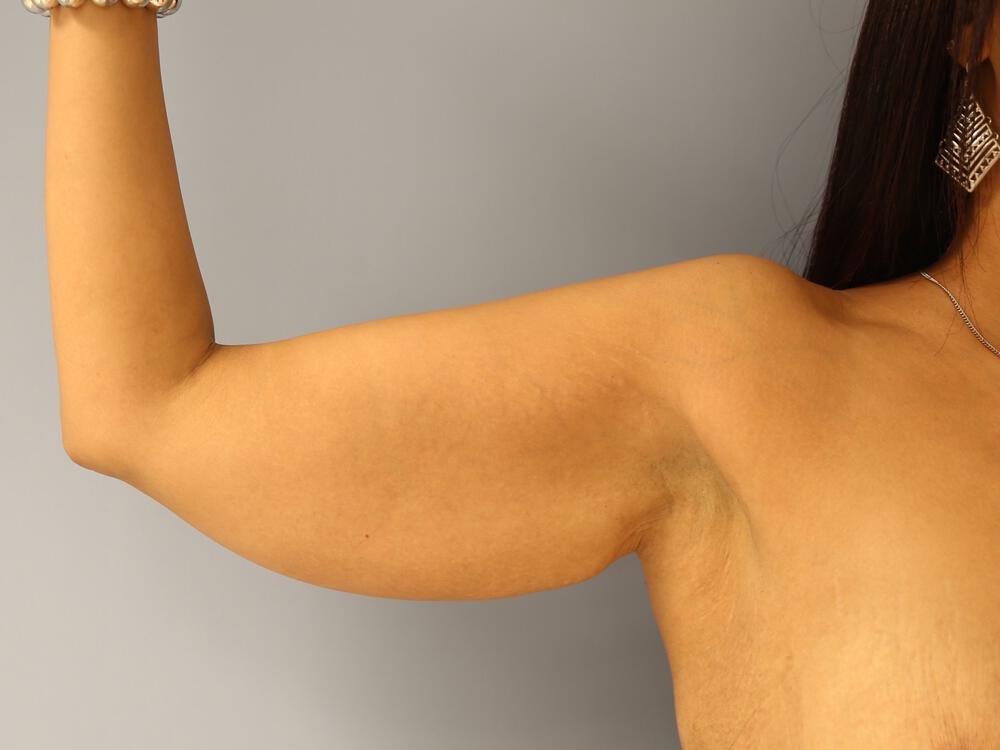 Armlift Before & After Image