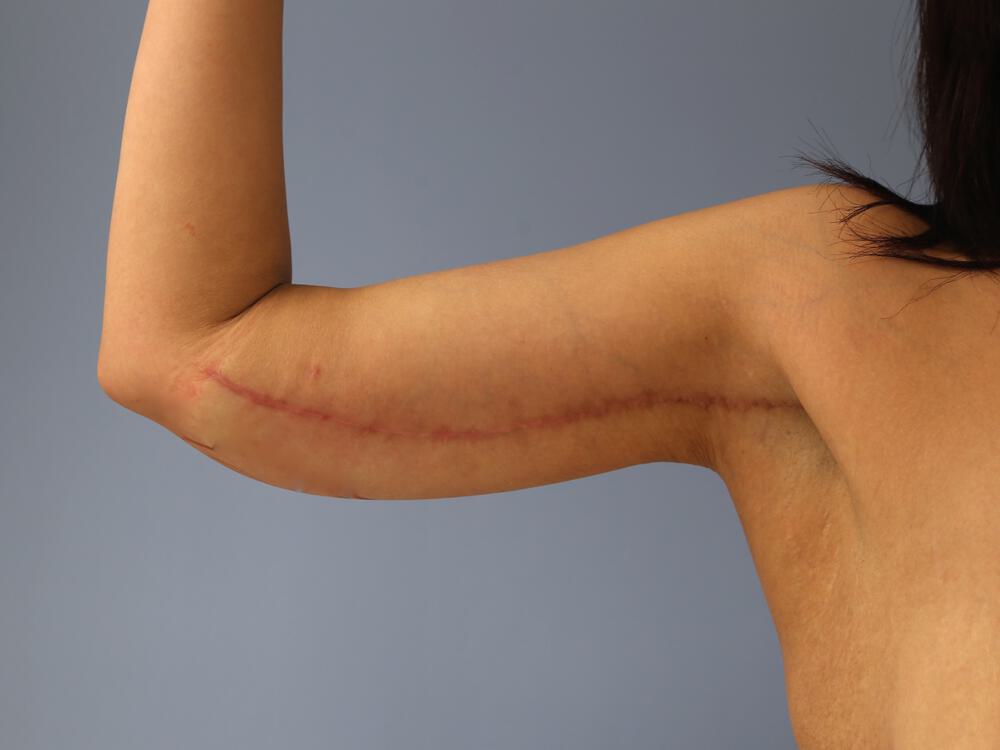 Armlift Before & After Image