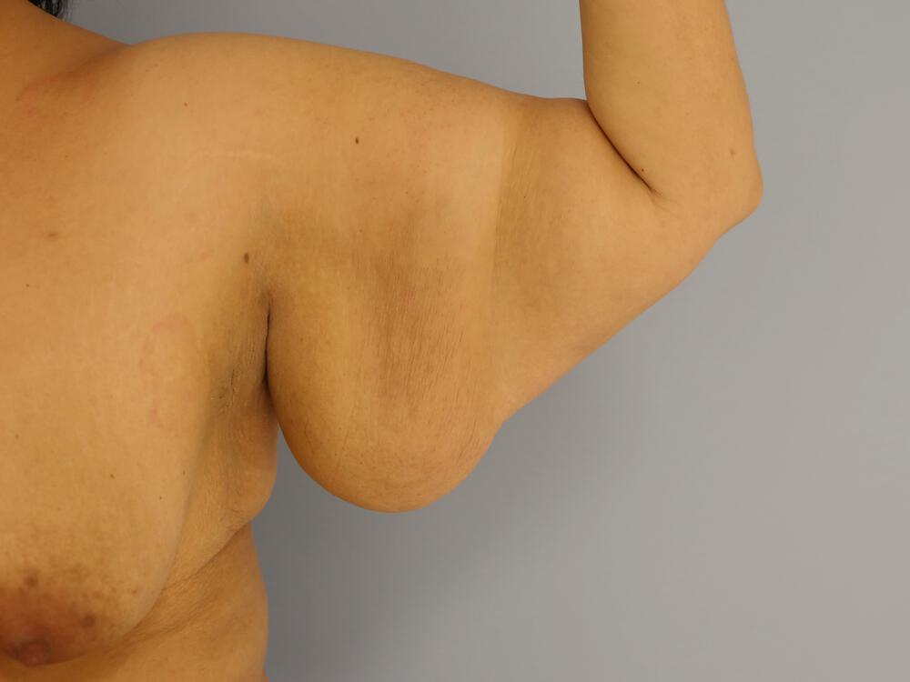 Armlift Before & After Image