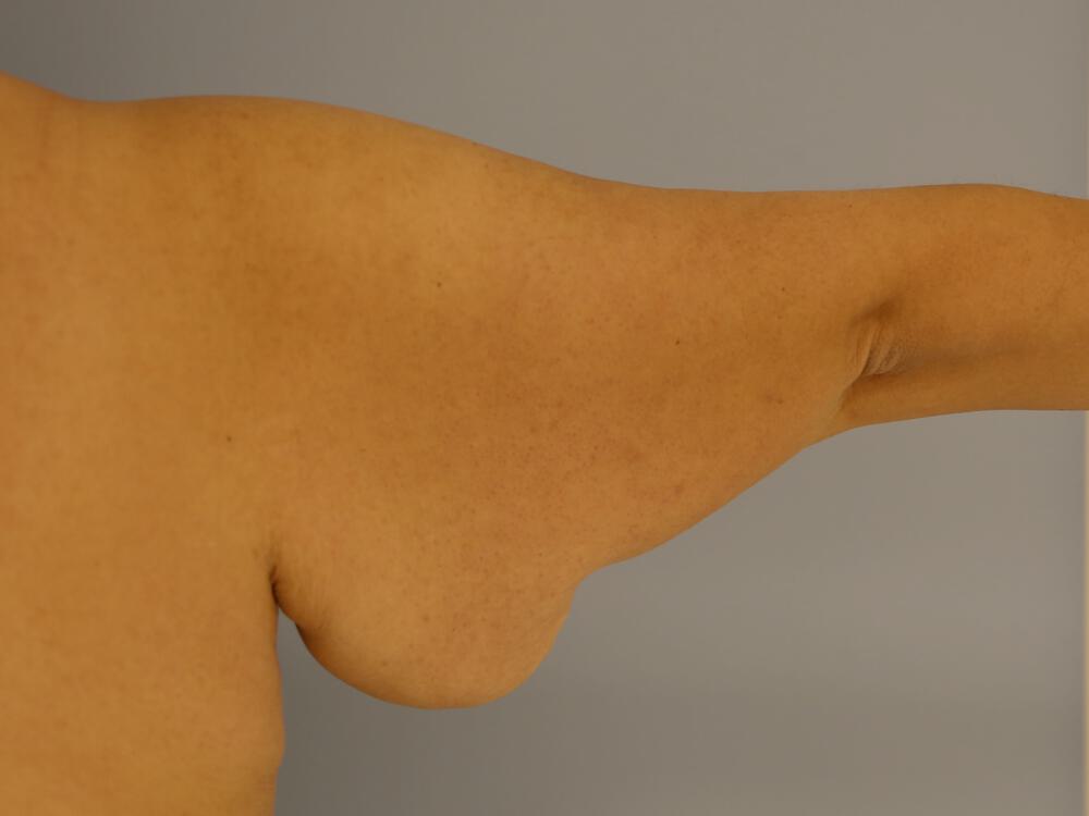 Armlift Before & After Image