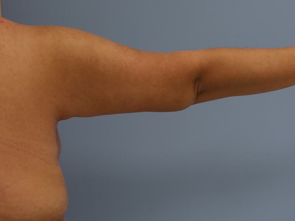 Armlift Before & After Image