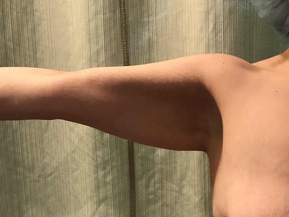 Armlift Before & After Image