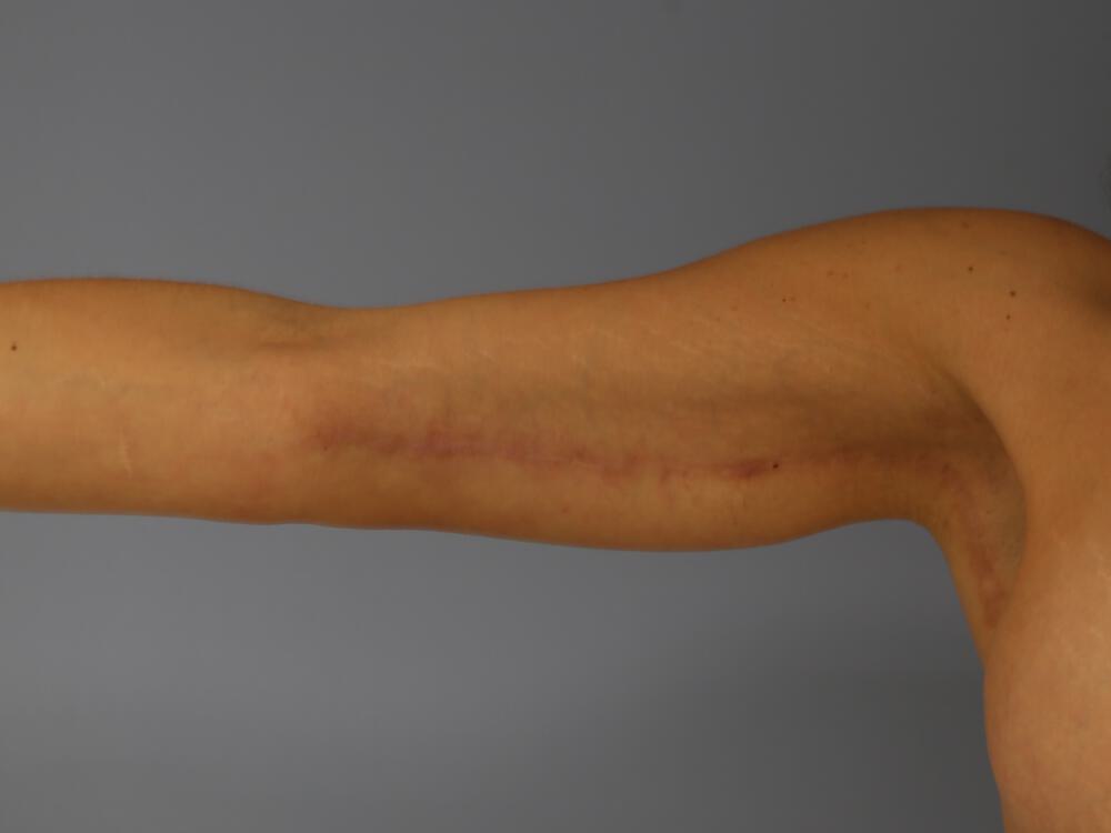 Armlift Before & After Image