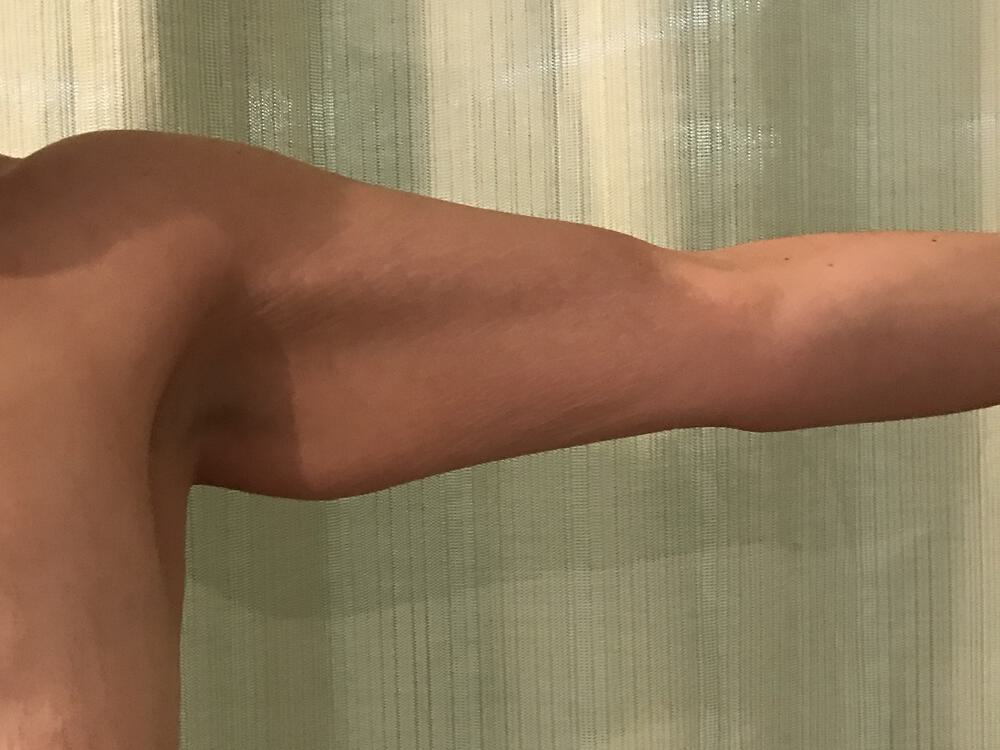 Armlift Before & After Image