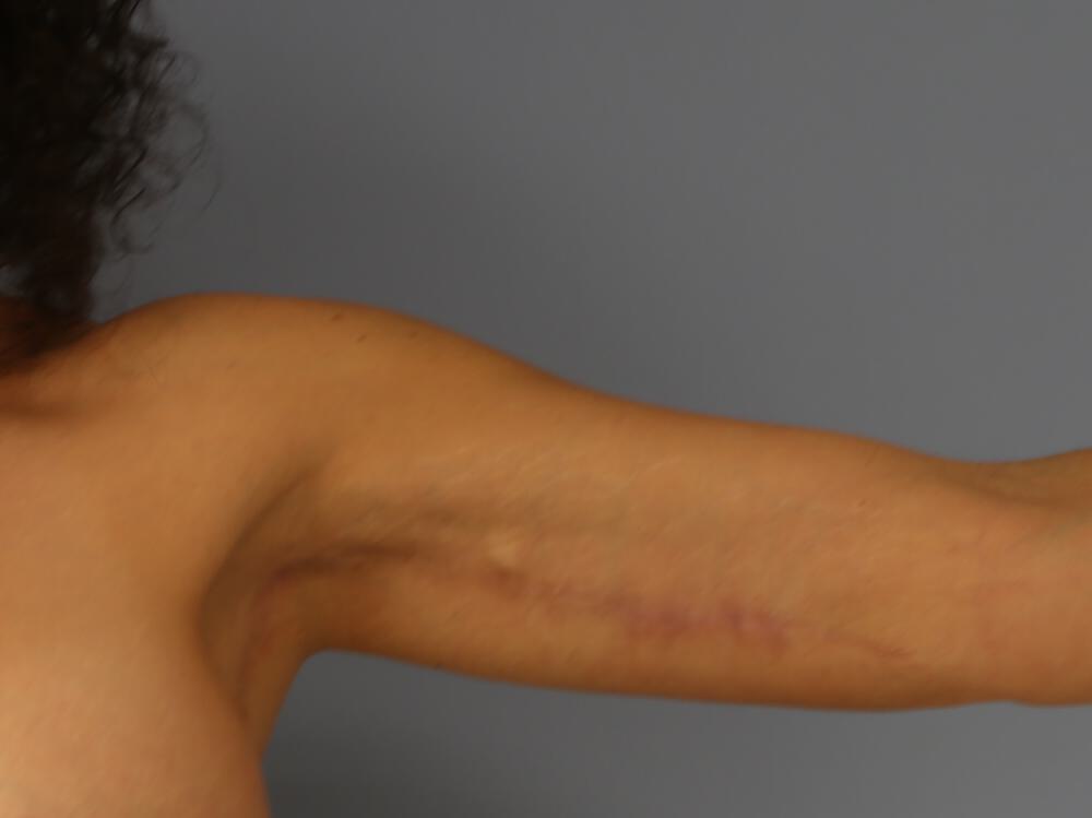 Armlift Before & After Image