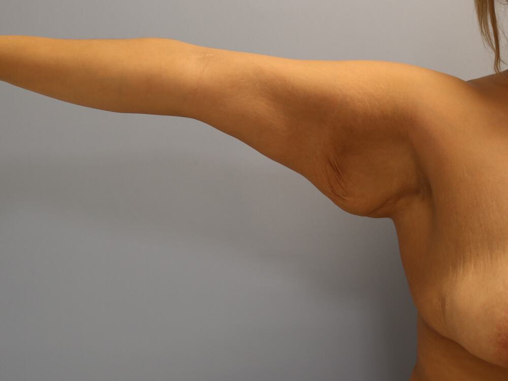 Armlift Before & After Image