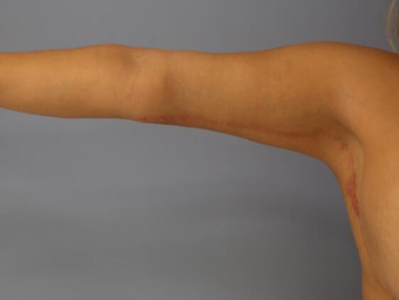 Armlift Before & After Image